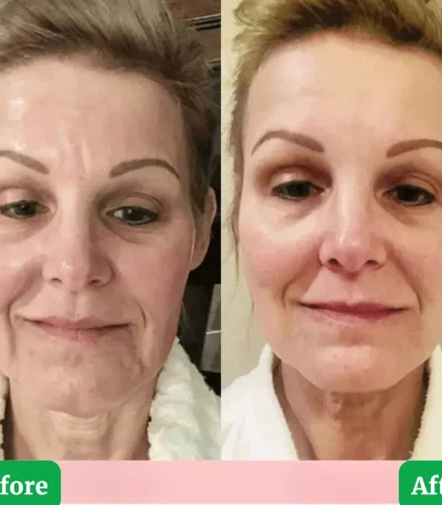7 in 1 EMS Face Lifting Device before after Proof Picture